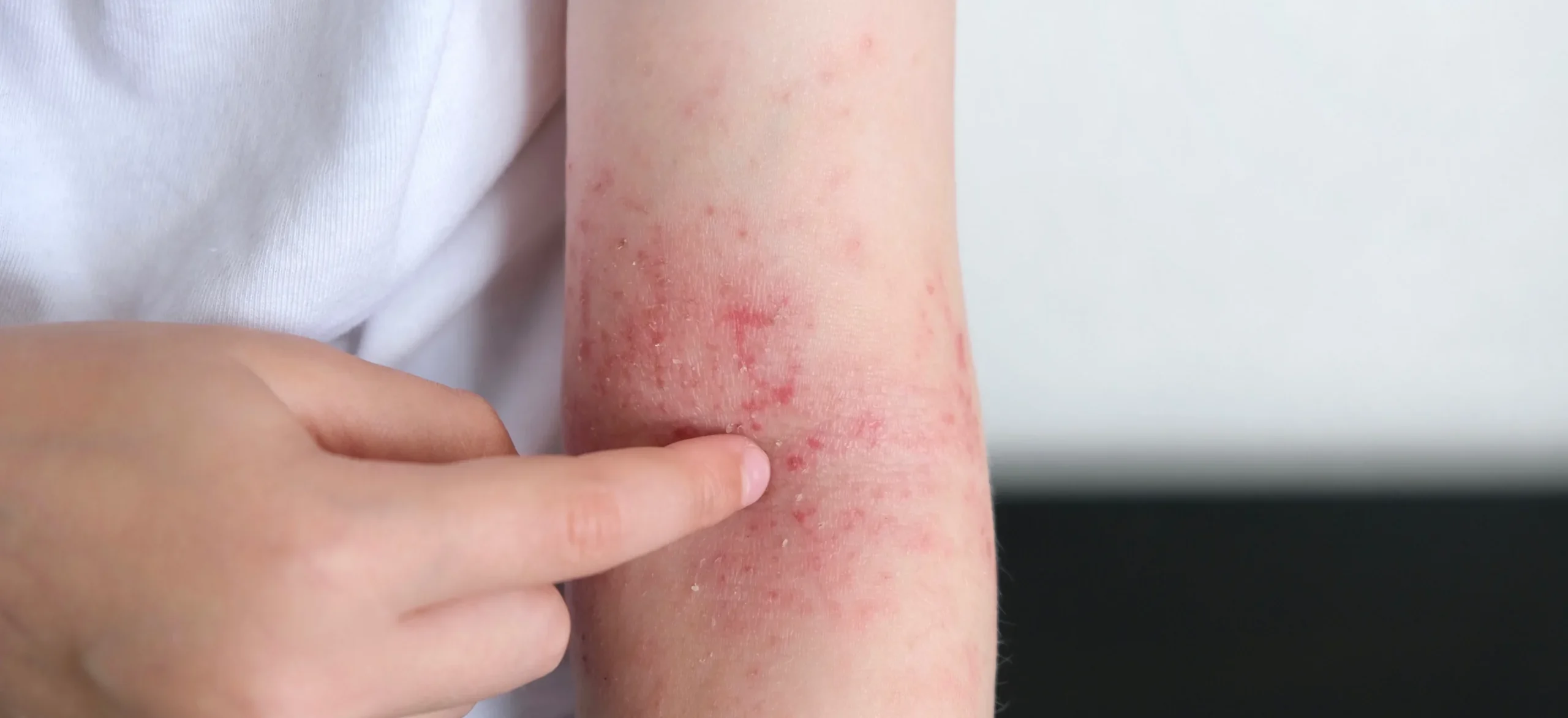 arm with red rash and irritation in studio - Psoriasis vs Eczema: Understanding the Key Differences