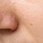 acne pimples on the nose close up - Does Tretinoin Help With Blackheads?