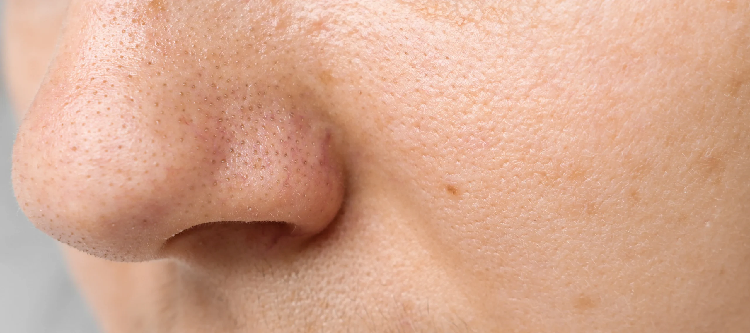 acne pimples on the nose close up - Does Tretinoin Help With Blackheads?