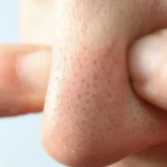 close up of skin with blackheads and pores - How to Heal a Popped Blackhead?