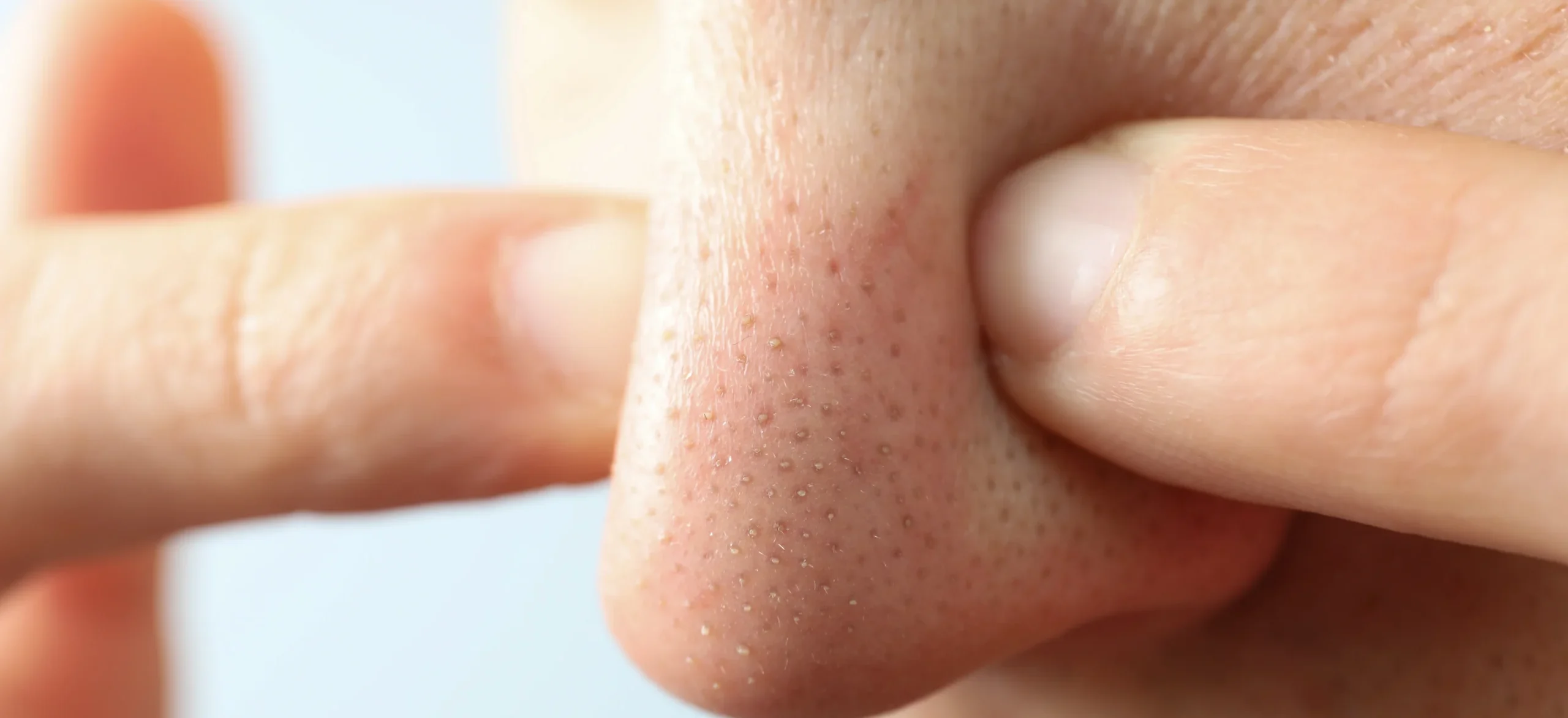 close up of skin with blackheads and pores - How to Heal a Popped Blackhead?