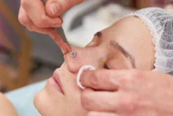 cosmetologist cleaning face close up - How to Heal a Popped Blackhead?