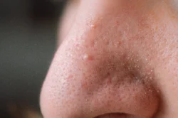 extreme close up of a person nose - How to Heal a Popped Blackhead?