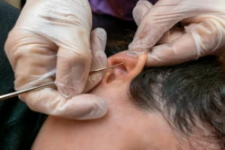 Blackheads in Ear: Causes, Symptoms, Safe Removal, Treatment, and Prevention