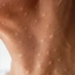 close up of skin on neck with bumps - How to Get Rid of Papules?