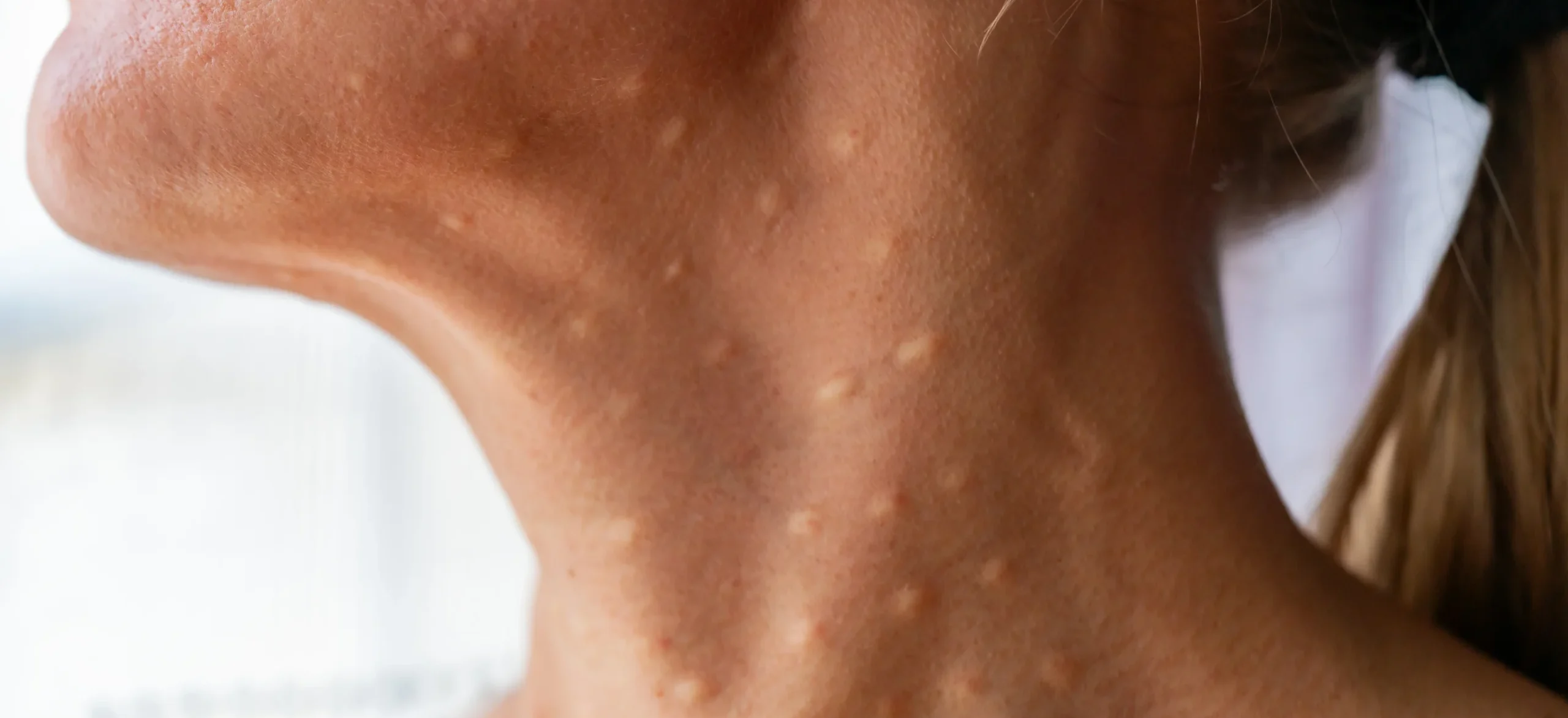 close up of skin on neck with bumps - How to Get Rid of Papules?