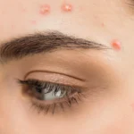 close up of woman with papule on face