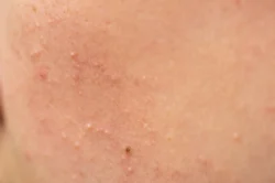 extreme close up of human skin texture - How to Get Rid of Papules?