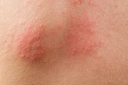 extreme close up of irritated inflamed skin - How to Get Rid of Papules?