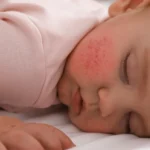 infant resting peacefully with mild skin condition - What Triggers Eczema in Babies and Infants?
