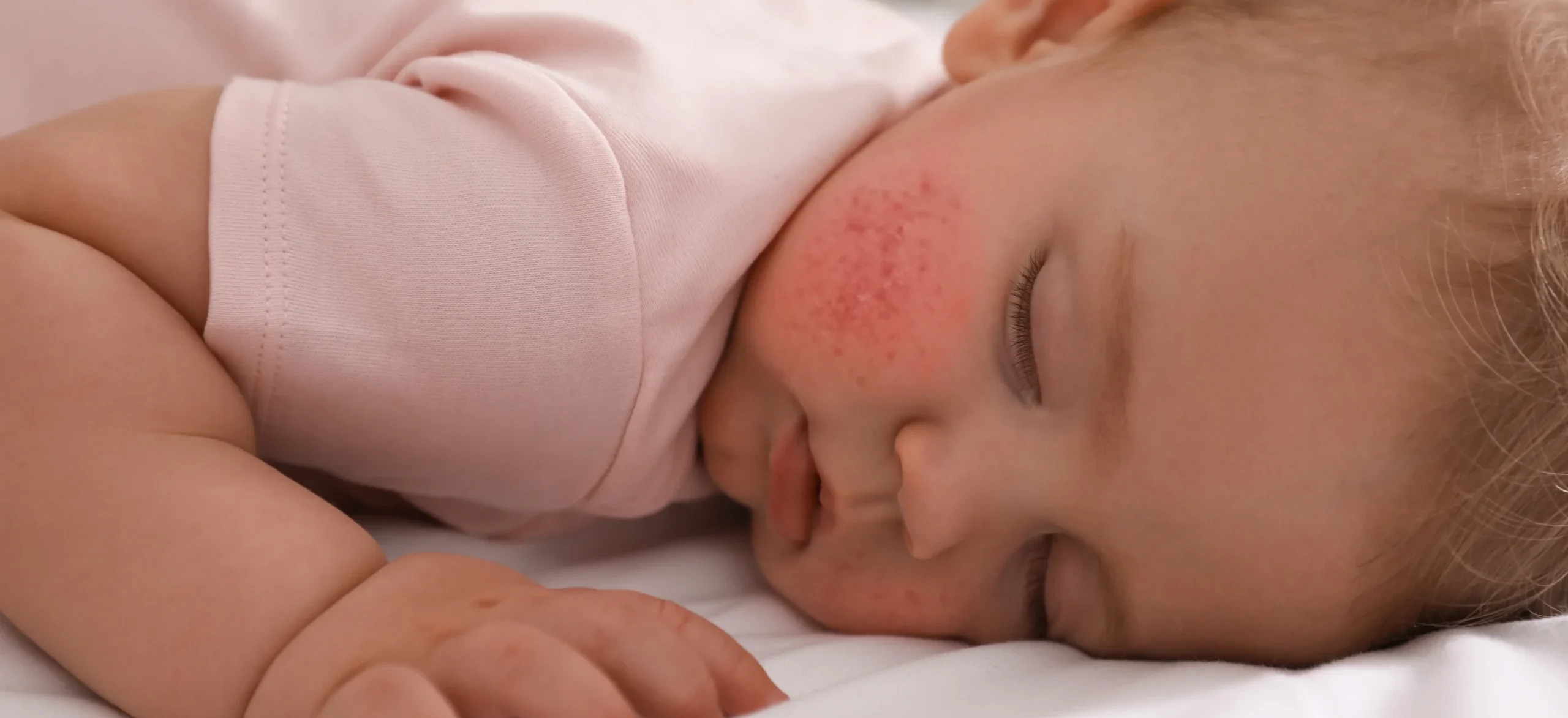 infant resting peacefully with mild skin condition - What Triggers Eczema in Babies and Infants?