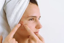 Is Witch Hazel Good for Acne? - woman with skin problems and whote towel