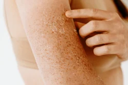 arm with pelling skin and freckles close up - Dry Skin: Causes, Prevention & Treatment