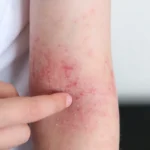 arm with red rash and irritation in studio - Can Stress Cause Eczema?