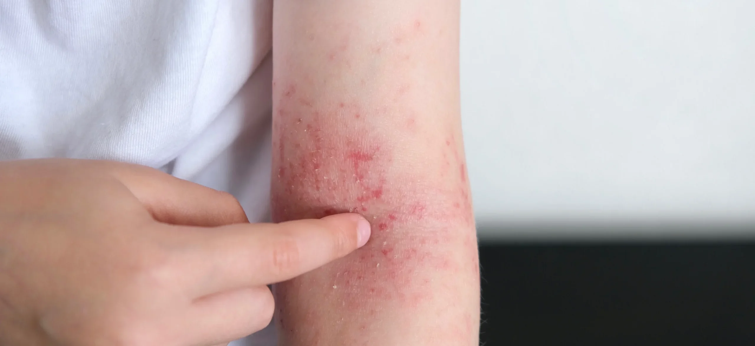 arm with red rash and irritation in studio - Can Stress Cause Eczema?