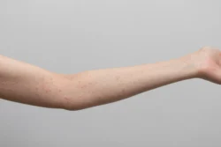 arm with red spots against grey - How Long Does Eczema Last? Duration, Flares, and Recovery