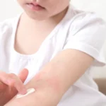 child applying cream to arm rash at home - How Long Does Eczema Last? Duration, Flares, and Recovery
