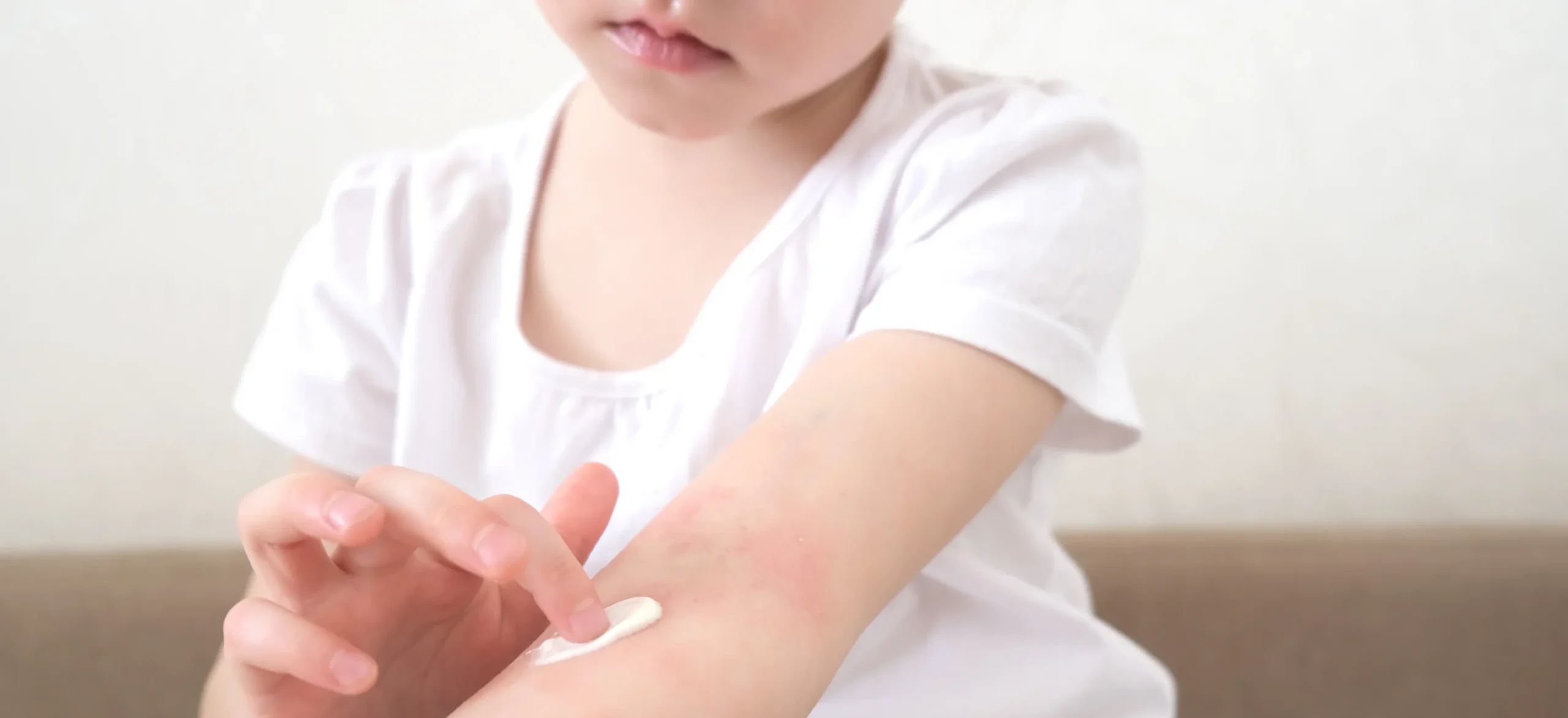 child applying cream to arm rash at home - How Long Does Eczema Last? Duration, Flares, and Recovery