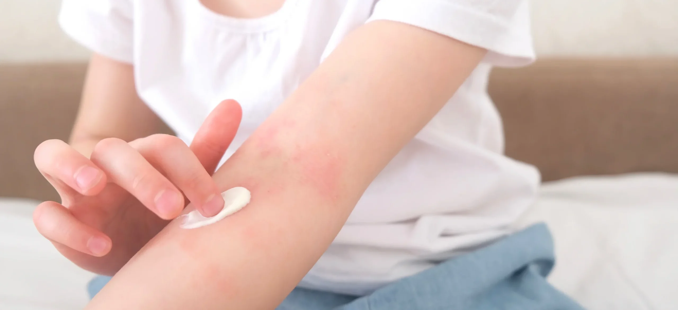 child applying cream to arm with skin irritation - Does Hydrocortisone Help Eczema?