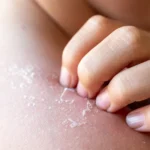 child hand scratching skin flaking on shoulder - Dry Skin: Causes, Prevention & Treatment