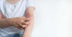 child scratches itchy arm in studio - Can Stress Cause Eczema?