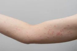 red rashes on an arm - Does Hydrocortisone Help Eczema?