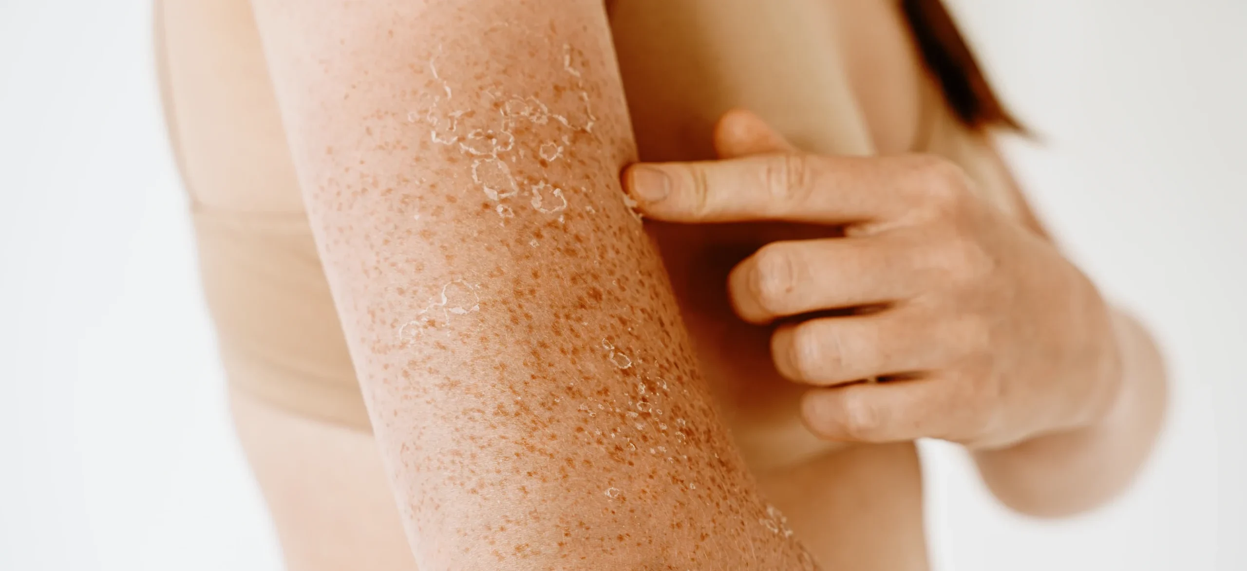 close up womans arm with dry skin -What Causes Dry Skin? Common Reasons & Solutions