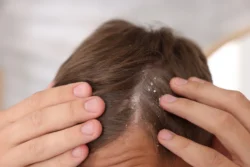 extreme close up of dandruff on a person scalp - How to Cure Dry Skin on Head: Causes, Treatment and Prevention