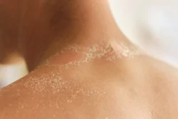 sunburned skin peeling after sun exposure