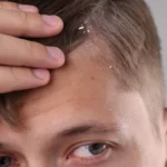 young man pointing to scalp with dandruff - How to Cure Dry Skin on Head: Causes, Treatment and Prevention