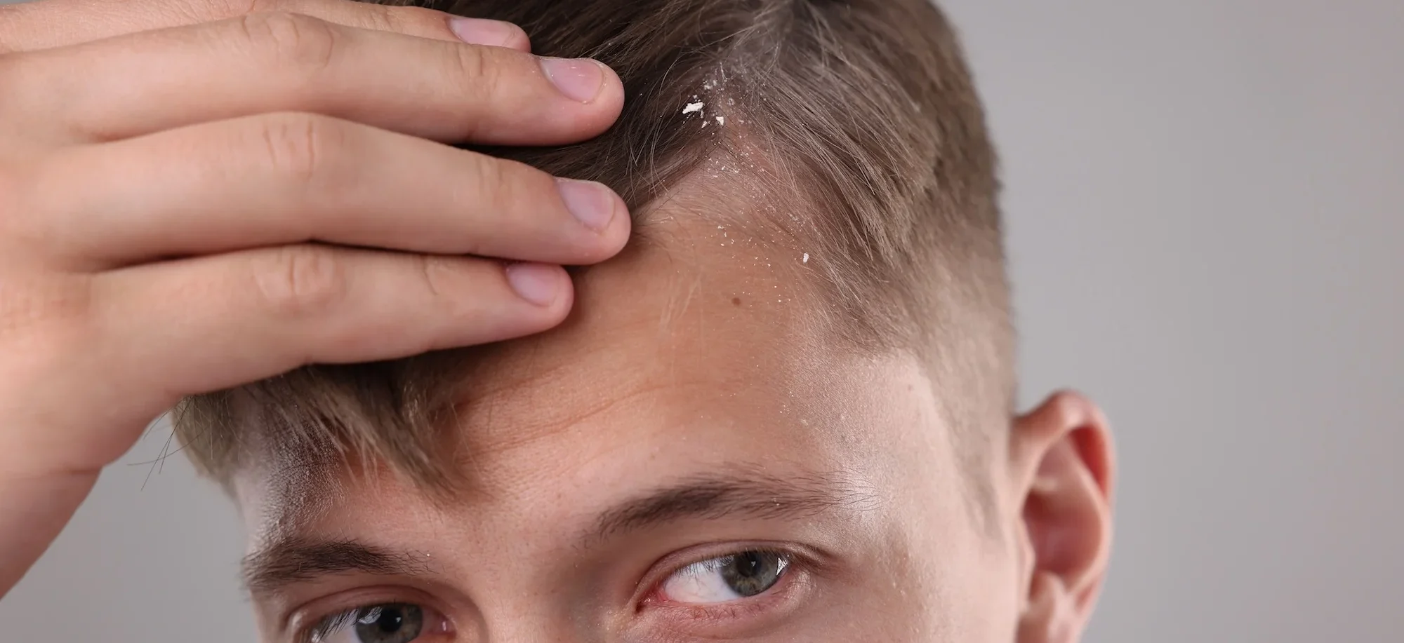 young man pointing to scalp with dandruff - How to Cure Dry Skin on Head: Causes, Treatment and Prevention