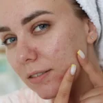 Can Dry Skin Cause Acne? What You Need to Know - young woman with natural skin posing in bathroom