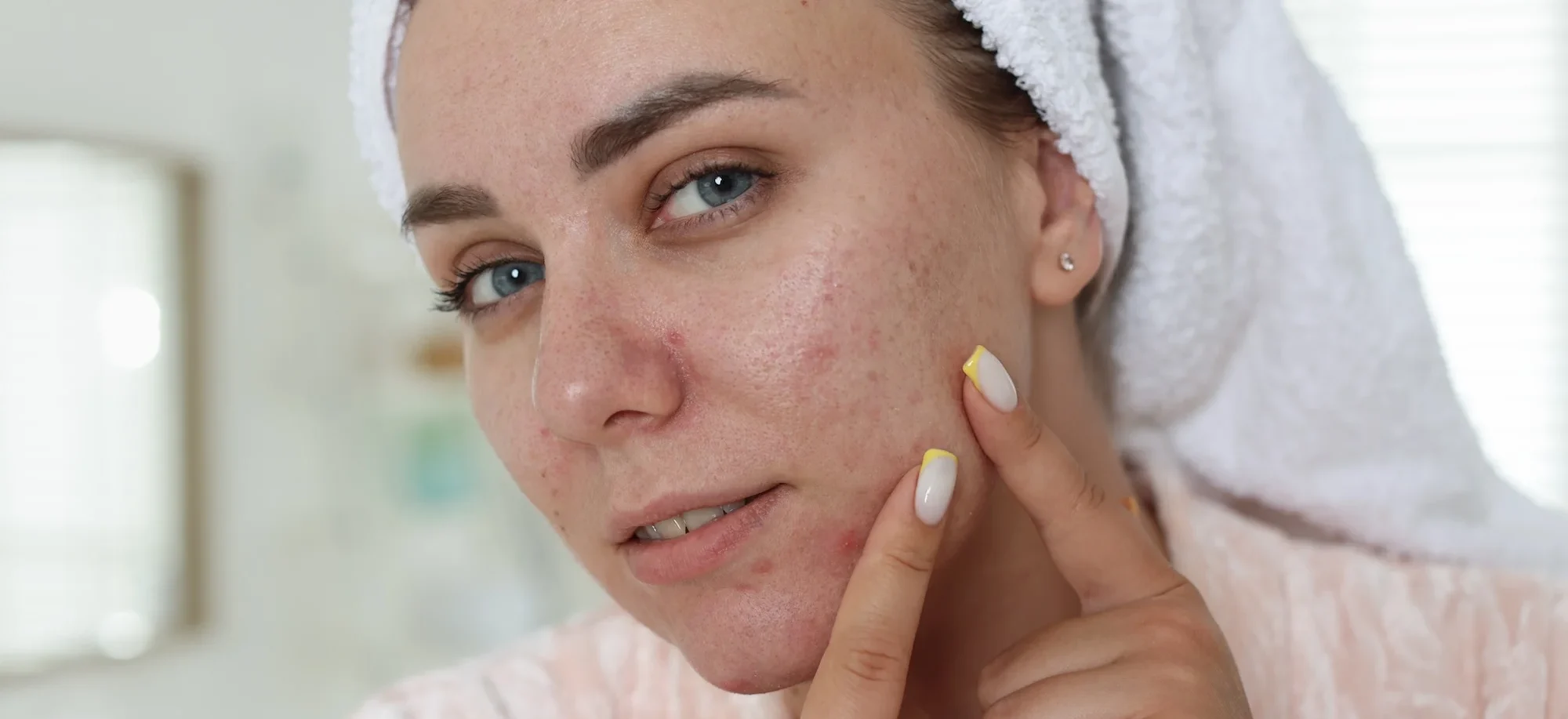 Can Dry Skin Cause Acne? What You Need to Know - young woman with natural skin posing in bathroom